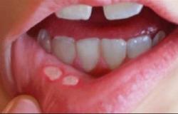علاج فطريات الفم بالمنزل وأسباب الإصابة بهاالجمعة 03/مايو/2024 - 09:58 م
مرض فطريات الفم، المعروف أيضًا باسم داء المبيضات الفموي هو عدوى فطرية يمكن أن تؤثر على الفم، وتشمل الأعراض تراكمًا أبيض أو أصفر على اللسان، وطعمًا كريهًا، وعدم الراحة.