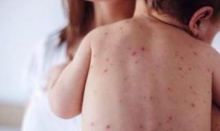 أزمة
      صحية
      فى
      إسرائيل..
      وفاة
      15
      طفلاً
      بسبب
      تفشى
      الحصبة